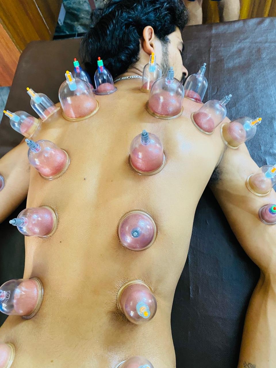 Cupping Therapy